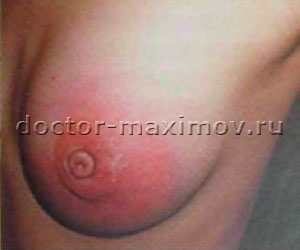 Нелактационный абсцесс